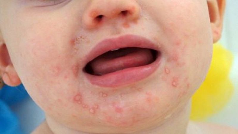 Trẻ em rất dễ bị ghẻ phỏng